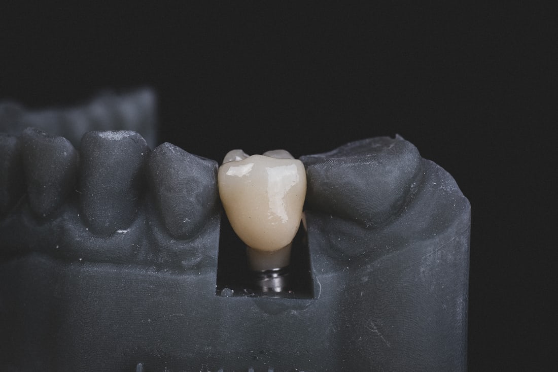 How to Get a Dental Implant and How to Use It